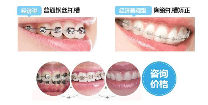 门牙有缝,担心矫正过程不美观,怎么办?