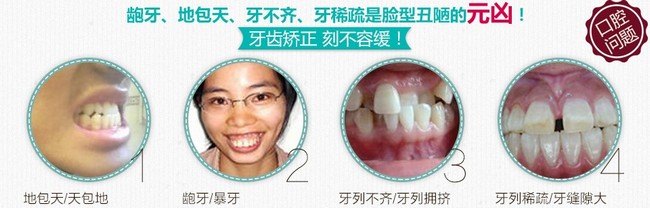 矫正牙齿,不一定需要拔牙。 为什么说矫正牙齿要拔牙