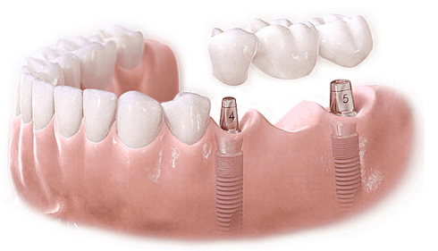镶半口牙得多少钱?