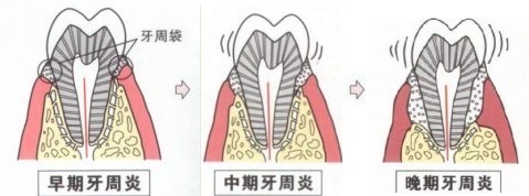 牙周炎一般疼几天